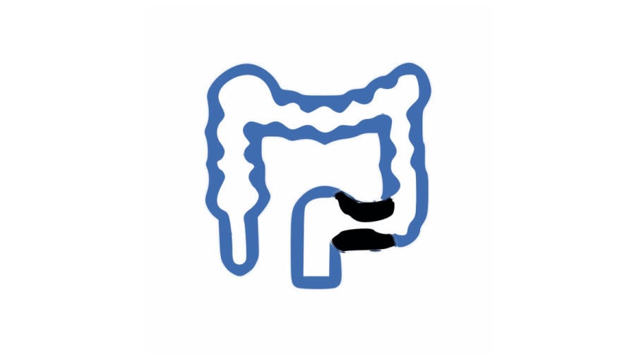 tratamiento cancer de colon en guadalajara