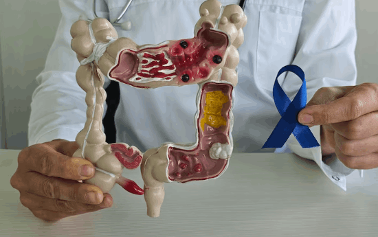 Tratamiento de cancer de colon en guadalajara