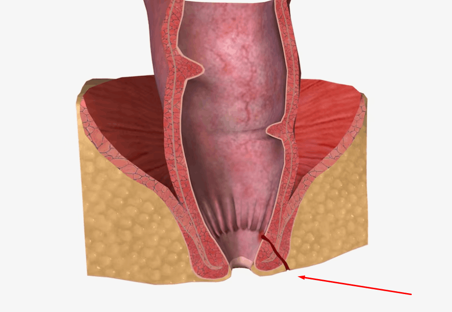 cirugia de fistula perianal en guadalajara