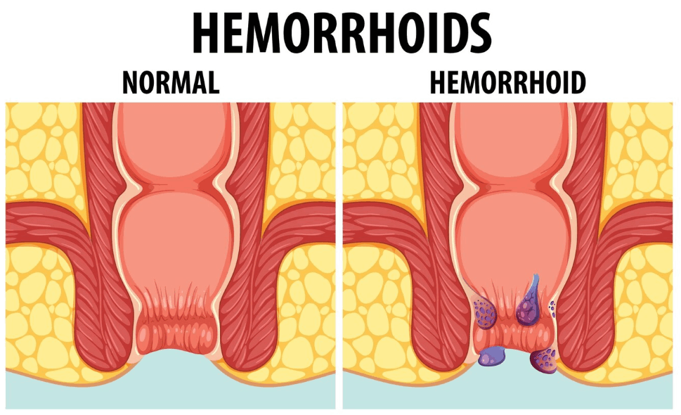 Tratamiento de Hemorroides en Guadalajara