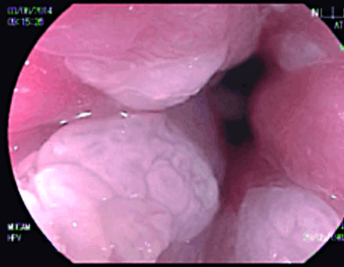 tratamiento verrugas vph verrugas anales en guadalajara