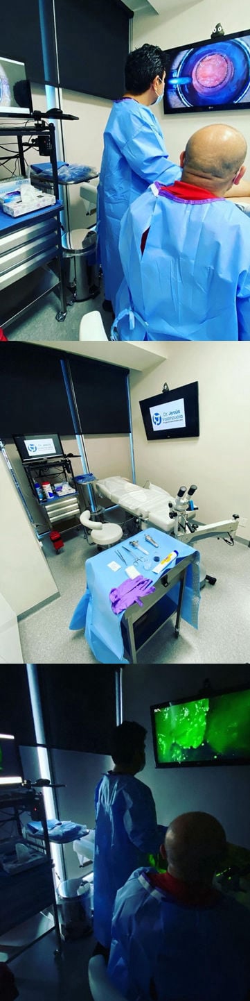 Tratamiento verrugas anales VPH en guadalajara