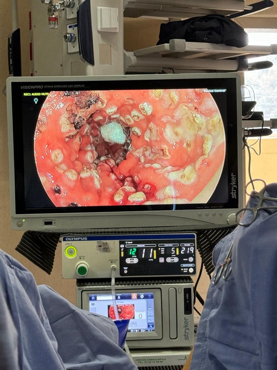 Tratamiento de cancer de colon en guadalajara